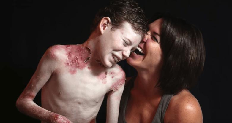 Perjuangan Jonathan Pitre The Butterfly Children Akhir Selesai